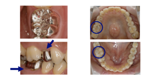 奥歯の被せ物