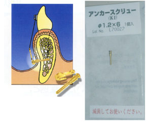 ミニスクリュウー