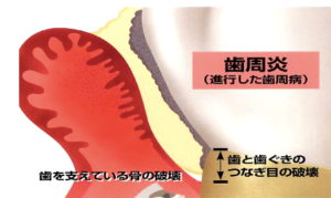 歯周炎