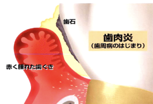 歯肉炎