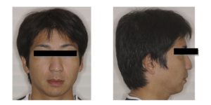 図1 ） 初診時の正面観・側貌観