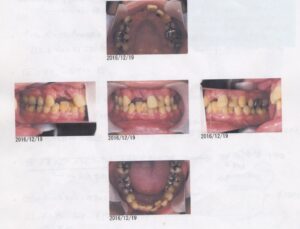 上の前歯が自然に抜けた　40歳男性