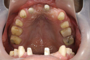 Periodontal disease