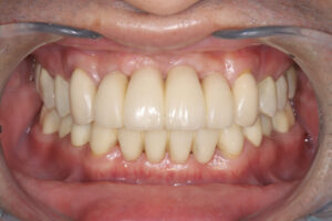 Periodontal disease, ceramic, occlusal reconstruction