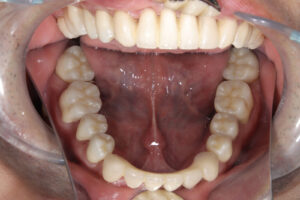 Periodontal disease, occlusal reconstruction
