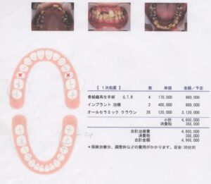 上の前歯が自然に抜けた40歳男性
