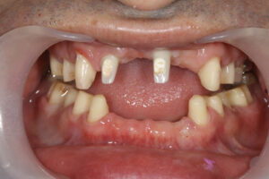 eramic, occlusal reconstruction