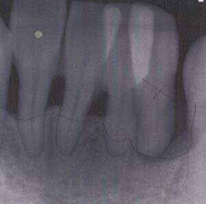上の前歯が自然に抜けた40歳男性