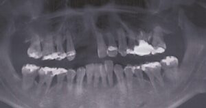 上の前歯が自然に抜けた40歳男性