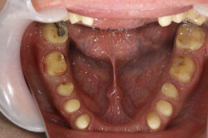 occlusal reconstruction