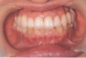 左上のインプラント希望５０歳女性