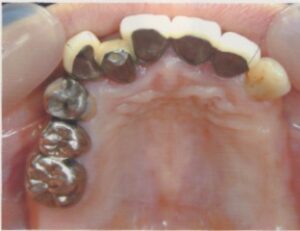 左上のインプラント希望５０歳女性