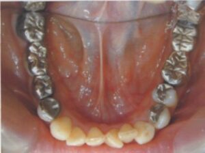 左上のインプラント希望５０歳女性
