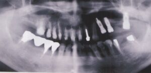 左上のインプラント希望５０歳女性