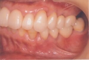 左上のインプラント希望５０歳女性