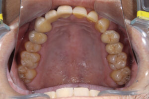 Something gets stuck between your teeth