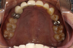 Something gets stuck between your teeth