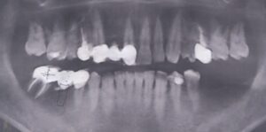 右上にものが詰まる５３歳男性