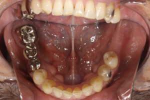 Something gets stuck between your teeth