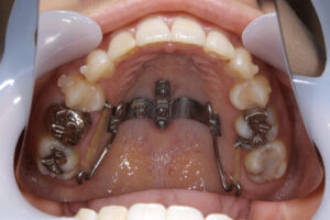 Implants Invisalign Ceramic