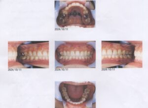 他の医院でのインビザライン失敗症例のリカバリー