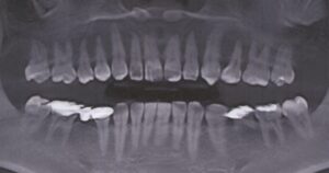上の前歯２本のラミネートベニア