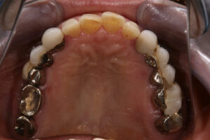 Gold Titanium dentures