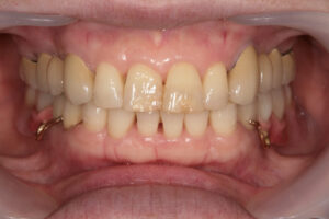 Gold dentures Titanium