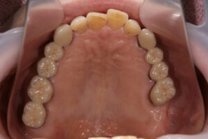 Gold dentures Titanium dentures