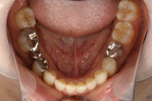 Laminate veneers, ceramic bridges, ceramic anlay