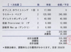 上の前歯２本のラミネートベニア
