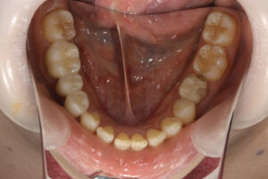 ceramic bridges, ceramic anlay