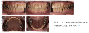 歯周組織再生療法 エムドゲイン