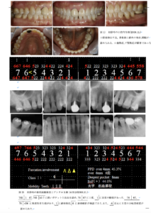 歯周組織再生療法エムドゲイン