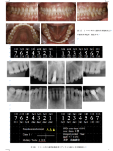 歯周組織再生療法 エムドゲイン
