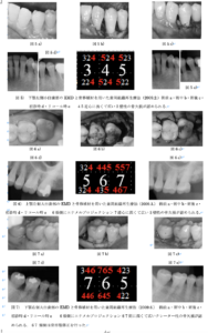 歯周組織再生療法 エムドゲイン