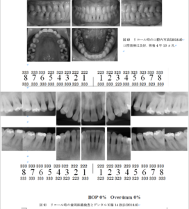 歯周組織再生療法エムドゲイン