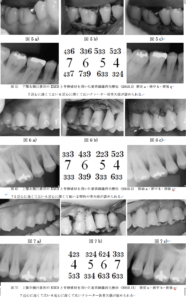 歯周組織再生療法エムドゲイン