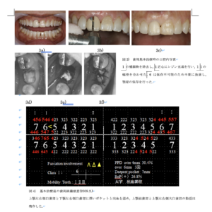 歯周組織再生療法エムドゲイン