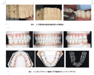 叢生矯正歯科治療