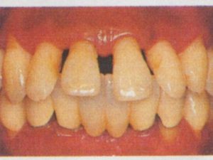 矯正と病的歯牙移動
