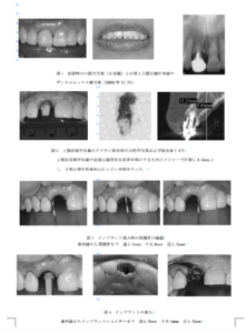 インプラント抜歯即時埋入