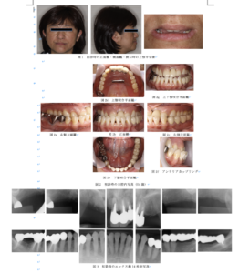 審美歯科学会投稿論文1 - 梅田北新地の歯医者かわさと歯科・矯正歯科