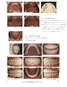 インプラント反対咬合