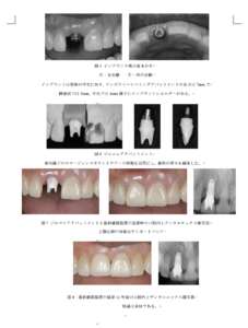 インプラント抜歯即時埋入