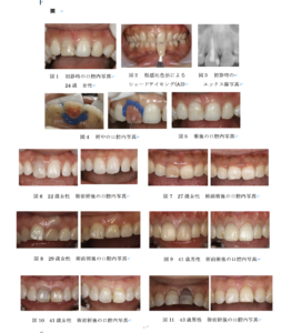 インターナルブリーチホワイトニング