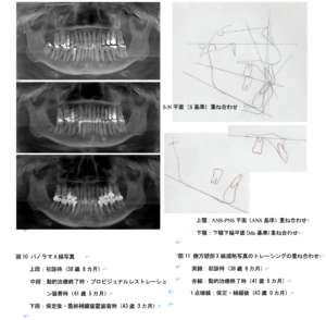 叢生ラミネートベニア