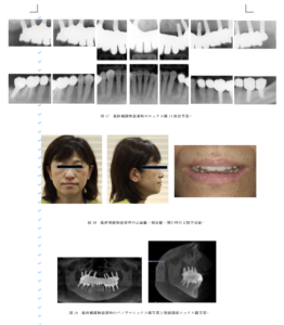 インプラント反対咬合