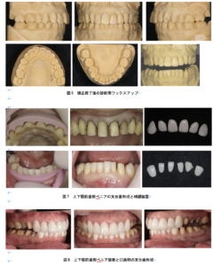 叢生ラミネートベニア