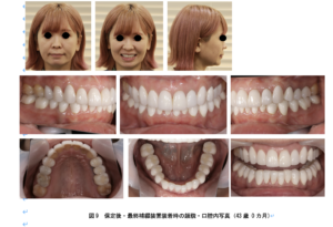 叢生ラミネートベニア